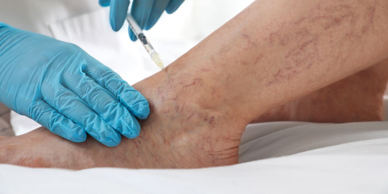 Varicose Vein Treatment Brampton