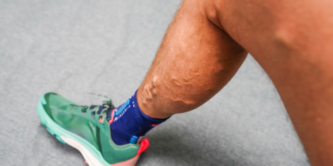 Varicose Vein Treatment Caledon