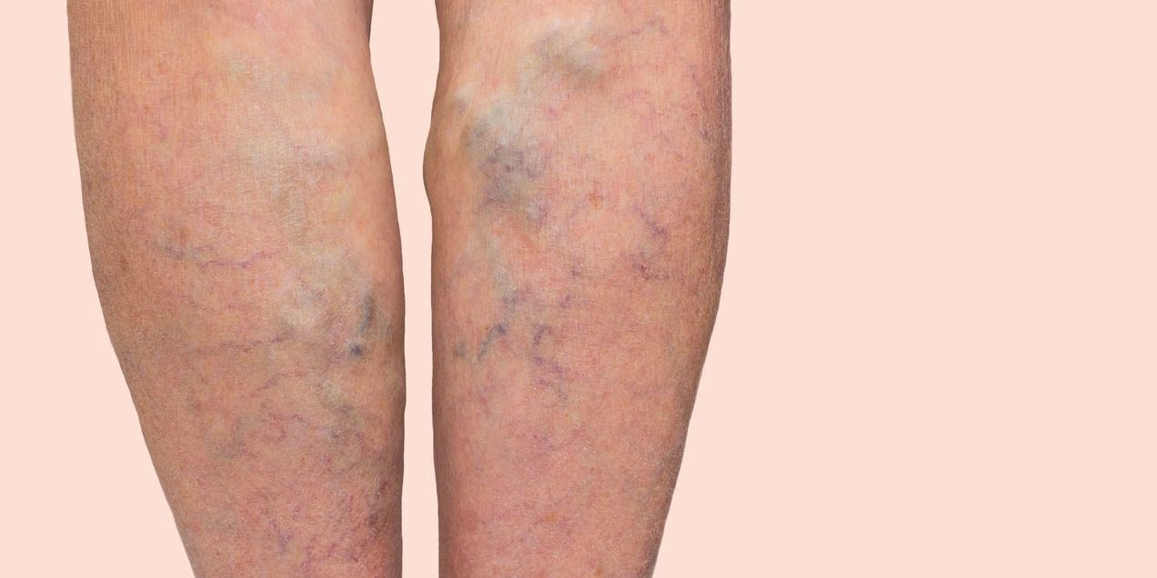 Varicose Vein Treatment Thornhill