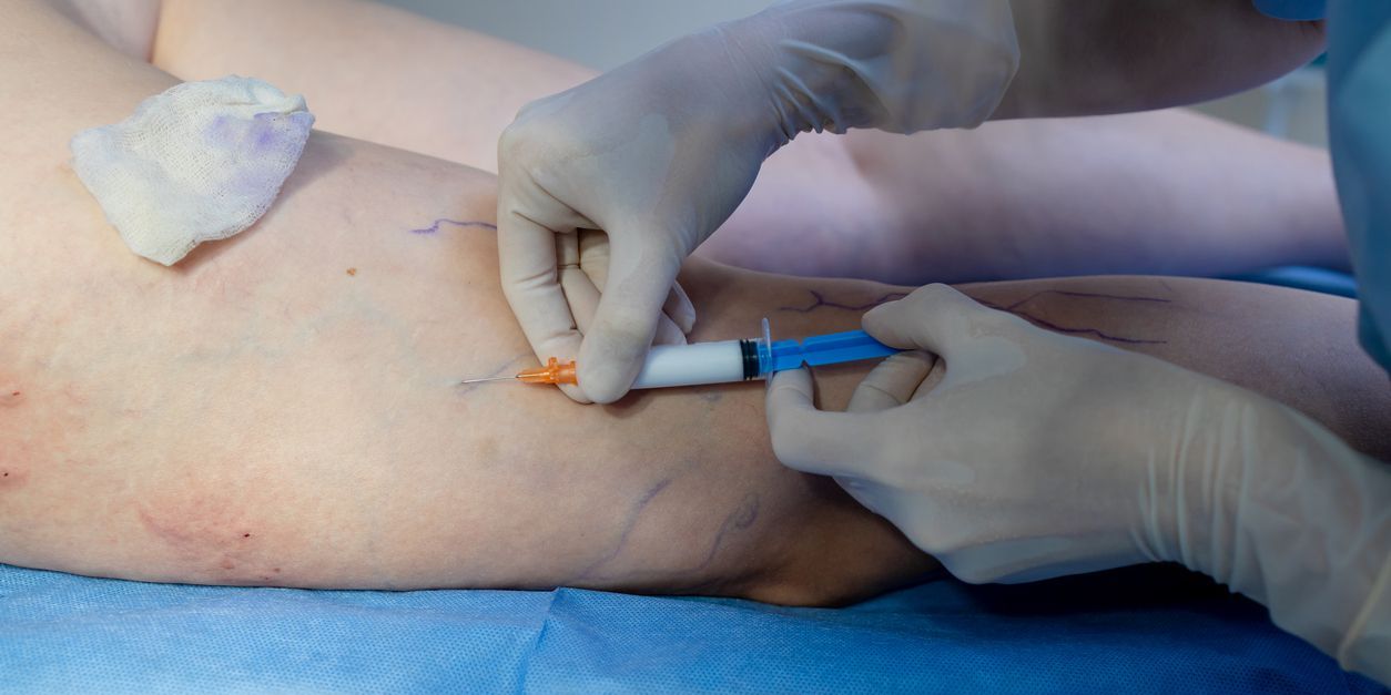 Varicose Vein Treatment Whitby