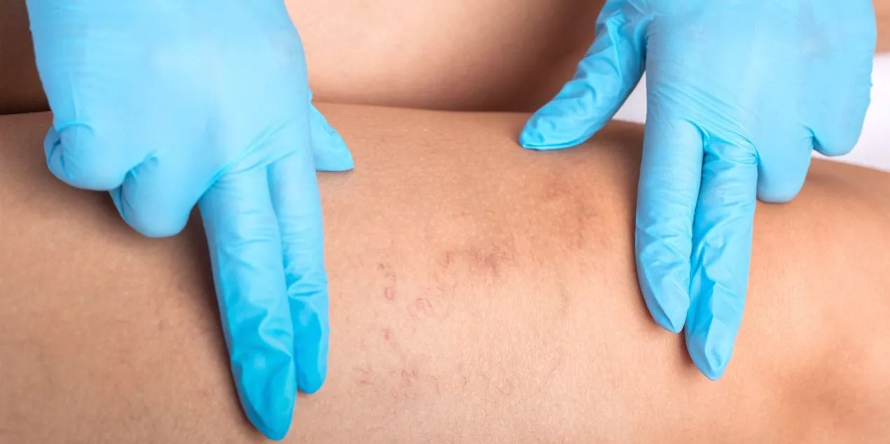 Endovenous Laser Ablation (EVLA) Pickering