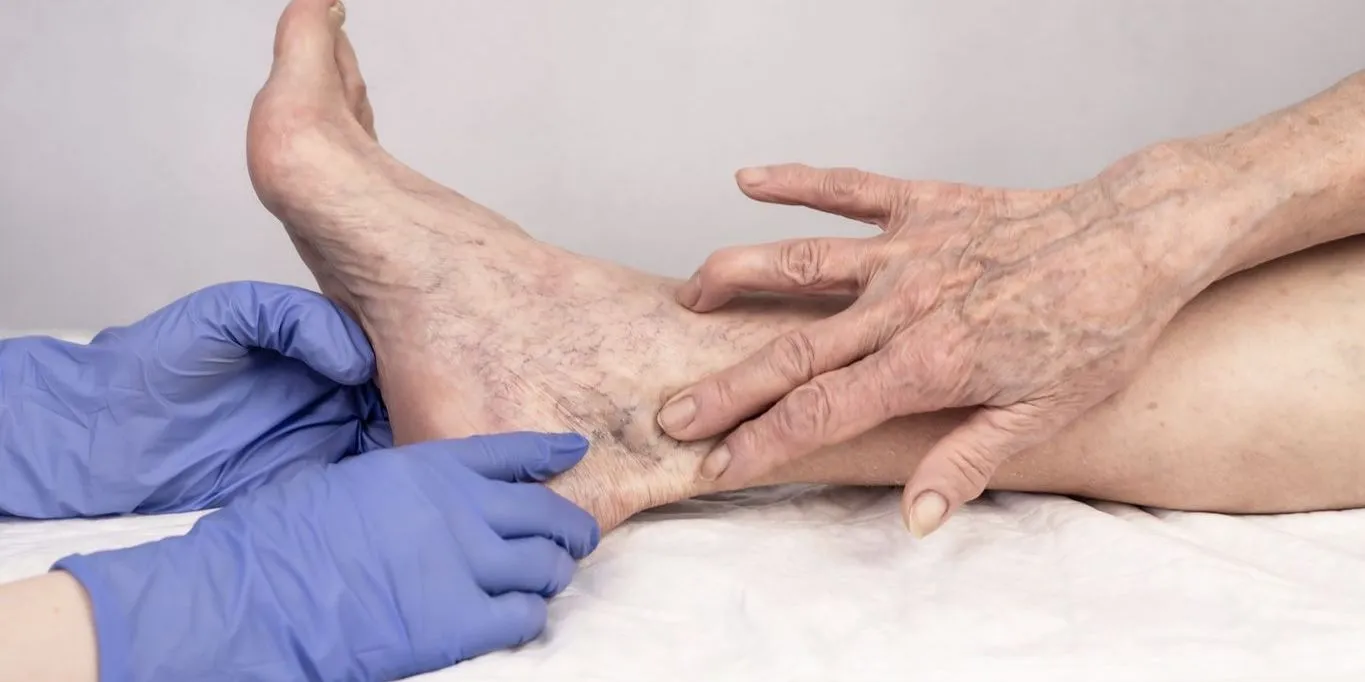 Endovenous Laser Ablation (EVLA) Thornhill
