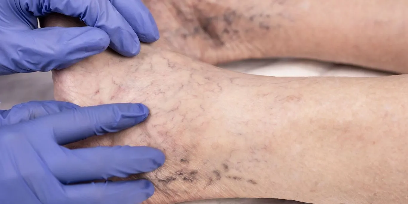 Endovenous Laser Ablation (EVLA) Whitby